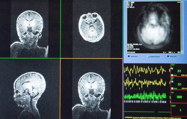 Infant Mri Cropped Web